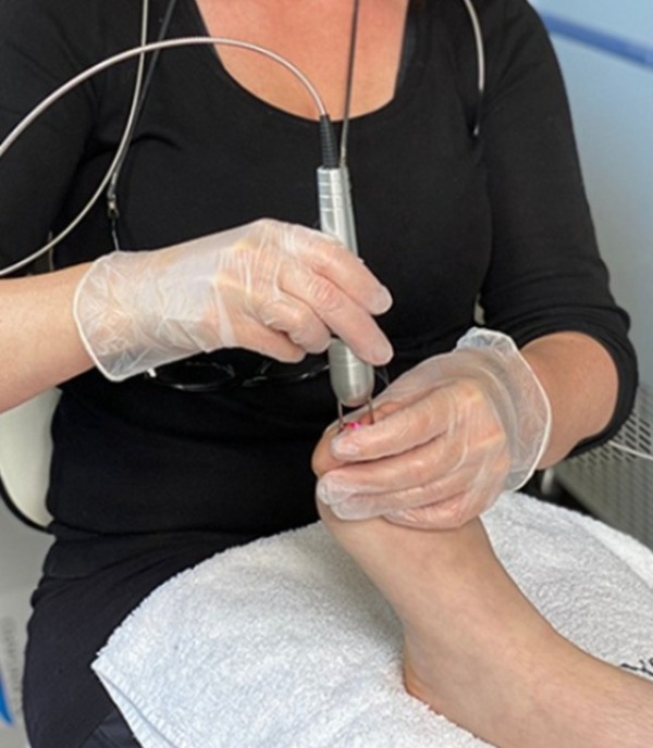 Foot care treatment with a handheld device performed by a practitioner wearing gloves.